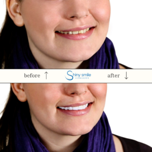 Single Top or Bottom Veneer - Image 4