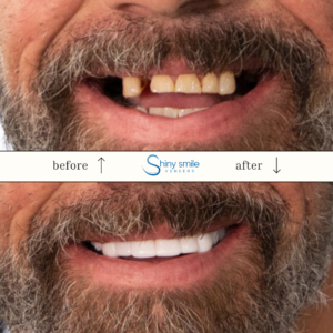 Single Top or Bottom Veneer - Image 8