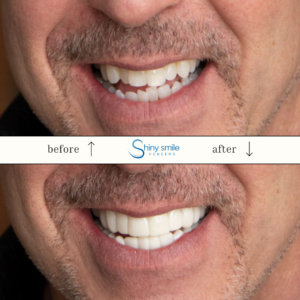 Single Top or Bottom Veneer - Image 9