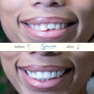 Single Top or Bottom Veneer - Image 10